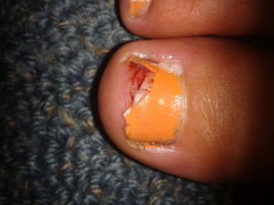 When half your toenail falls off...